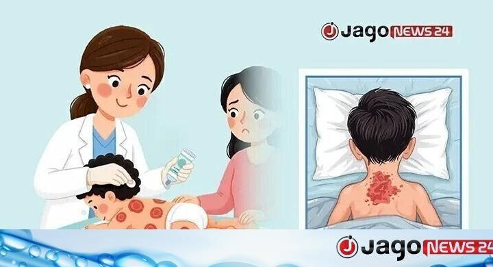 দেশে হামের উপসর্গে আরও দুজনের মৃত্যু