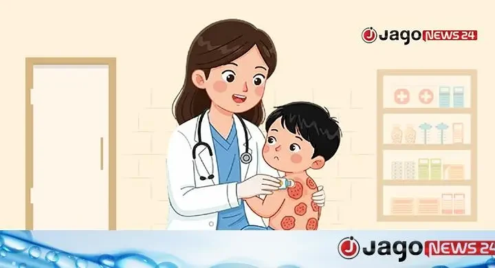 হামের উপসর্গ নিয়ে আরও ৩ প্রাণহানি